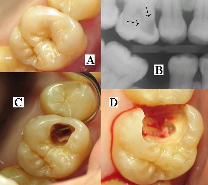 Root Canal Treatment in La Grange, IL